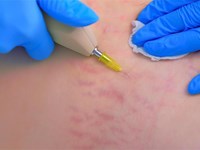 ¿Cómo te ayuda la carboxiterapia a reducir la grasa localizada?