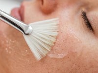 ¿En qué consiste el peeling químico?